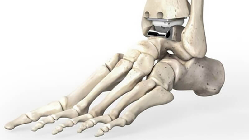 Ankle Prosthesis